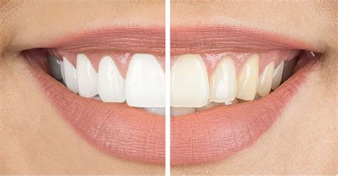 The Magic of Natural Teeth Whitening: Effective Home Remedies Revealed